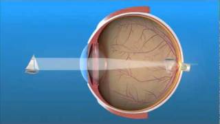 Visión de Lejos Hipermetropía [upl. by Parris531]