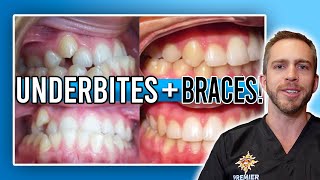 Underbite Braces Treatment BEFORE amp AFTER [upl. by Uzzia]