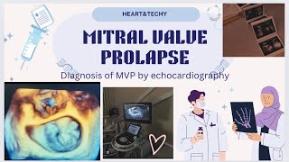 MITRAL VALVE PROLAPSE [upl. by Ylrebmi472]