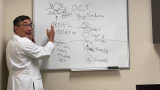 OCT in papilledema [upl. by Annawad]