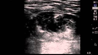 Ultrasound guided interscalene brachial plexus block [upl. by Rawden]