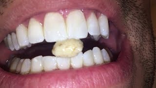 Most dangerous Tonsil stone removal [upl. by Nimad351]