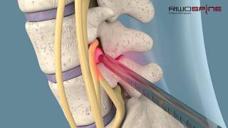 Fullendoscopic spinal treatment of herniated discs and spinal canal stenosis [upl. by Marin]