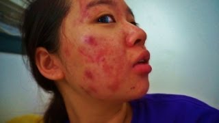 My Acne Story  18th Week of Accutane [upl. by Streeter]