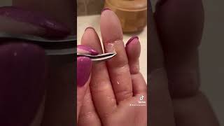 Finger blisters with palmoplantar keratoderma hand callus EPPK  Mar 13 2023 [upl. by Aleel]