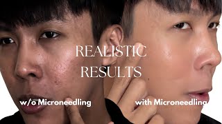 Lets do Microneedling on half of my face  Acne scars treatment [upl. by Llecrep]