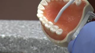 New cavity treatment offers no drilling no filling [upl. by Engis425]