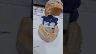 Fixed Prosthesis Ready for Patient By Dr Indu Bhushan BDSMDS  RADHA DENTAL CLINIC Ramnagar [upl. by Neibaf]