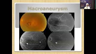 Optical coherent tomography OCT basics and in different vascular and hereditary retinal diseases [upl. by Ahsahs578]