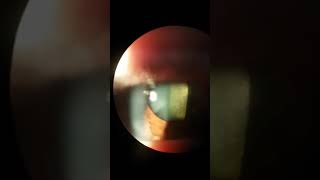 Posterior subcapsular cataract [upl. by Amelina]