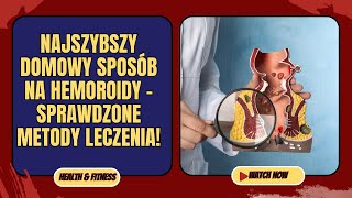 Najszybszy domowy sposób na hemoroidy – sprawdzone metody leczenia [upl. by Merriman985]