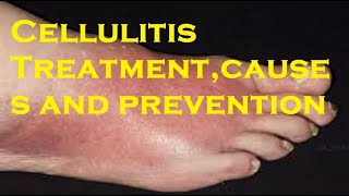 Cellulitis Treatmentcauses and prevention [upl. by Aleuname]