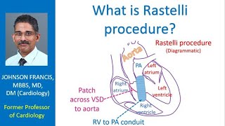 What is Rastelli procedure [upl. by Ikram]