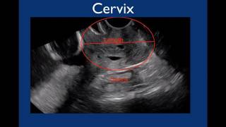 Pelvic Ultrasound [upl. by Merril]