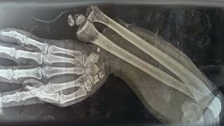 A Boy Ate 150 Gummy Vitamins For Breakfast This Is What Happened To His Bones [upl. by Lapides]