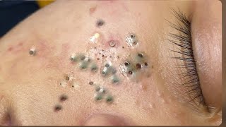 Cleaning Blackheads amp Whiteheads Satisfying Removal473 [upl. by Annerol371]