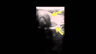 ultrasound intubation [upl. by Nishi564]