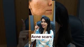 Acne scars treatment suggestions for best results [upl. by Klump]