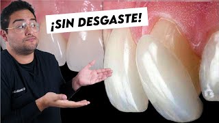 CARILLAS DENTALES LO QUE NADIE TE DICE ¿PORQUE NO DESGASTAR ¿TE QUEDAS SIN DIENTES [upl. by Kumler]