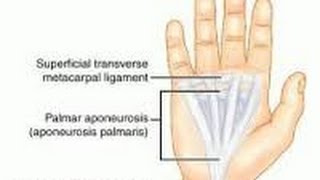 APONEUROSIS  INFLAMACIÓN DE LOS TENDONES DE LA MANO [upl. by Ravens]