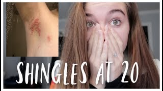 Getting Shingles At 20 Years Old [upl. by Ovid]