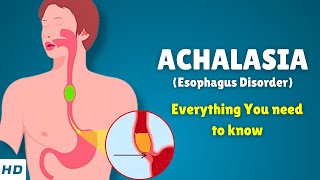 Achalasia Esophagus Disorder – Causes Signs and Symptoms Diagnosis amp Treatment [upl. by Anelrihs]