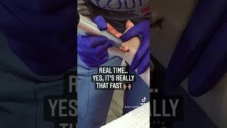 Tattoo Removal with the Picoway laser [upl. by Nahshon671]