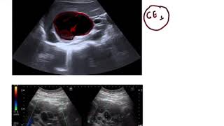 Hydatid Cyst of liver STAGING [upl. by Eiramaliehs]