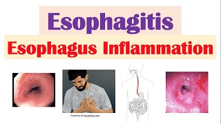 Esophagitis Esophagus Inflammation Causes Risk Factors Signs and Symptoms Diagnosis Treatment [upl. by Ezalb]