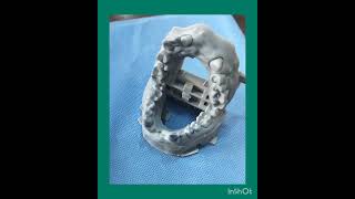 zirconia Crown fabricated with help of Dental Scan without impression procedure [upl. by Asimaj]