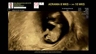 Acrania early diagnosed 8weeks  10 weeks [upl. by Slen184]