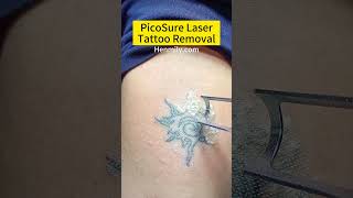 PicoSure Laser Tattoo Removal Pico Laser Before and After Picosecond Laser Pico Laser machine [upl. by Kasper]