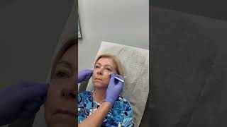 Restylane for Youthful Skin  Spyglass Dermatology [upl. by Nywroc179]