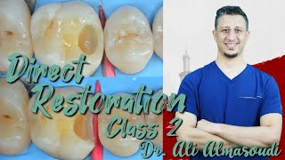 Direct composite restoration upper 6 class 2 Dr Ali Almasoudi [upl. by Marutani952]