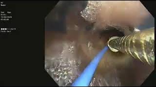 Bronchoscopic bronchopleural fistula closure  Sequential Balloon occlusion  Sphigot placement [upl. by Aloiv185]