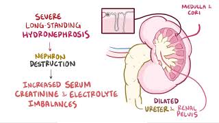 Hydronephrosis  Renal Pathology  Osmosis [upl. by Ronal]