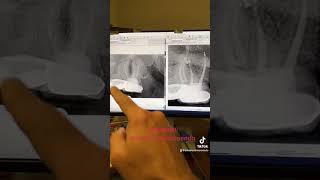 An endodontist missed a canal rootcanal endodontist dentistry teeth dentist [upl. by Udall]