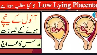 What is Low Lying Placenta in Pregnancy amp Treatment  Is Normal Delivery Possible  Urdu  Hindi 🌐 [upl. by Valida339]