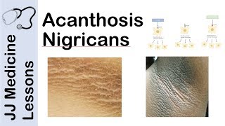 Acanthosis Nigricans  Risks Pathogenesis and Treatments [upl. by Jim]