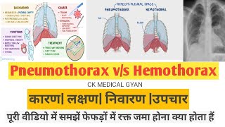 hemothorax vs pneumothorax क्या होता है फेफड़ों में रक्त जमा होने से कैंसर हो सकता है [upl. by Akimet]