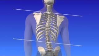 Scoliosis  Curvature of the Spine [upl. by Pulling656]