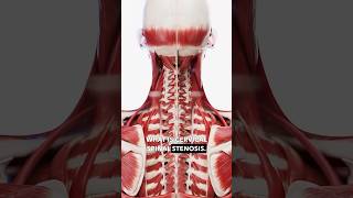 What is cervical spinal stenosis spinalstenosis cervicaldischerniation neckpainrelief neckpain [upl. by Jonina]