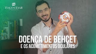 O que é Doença de Behçet Sintais e sintomas Behçet  Tratamento Behçet  Dr Tiago César Oftalmo BH [upl. by Dhiren147]