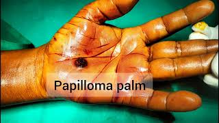 Viral Papilloma of palm Excision under anaesthesia [upl. by Aynek770]