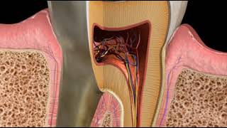 Abscess Combined Lesion [upl. by Eednak575]