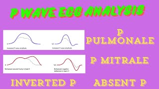 ECG P wave Analysis amp Abnormalities [upl. by Lebisor]