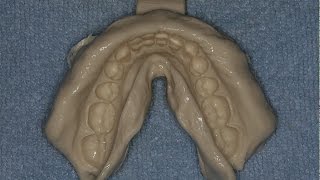 Accurate and Easy Alginate Impressions and Stone Casts [upl. by Ennovehc286]