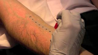 Skin Prick Allergy Test [upl. by Westland]