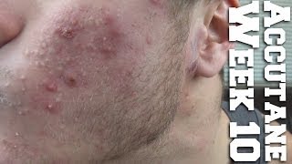 Week 10 of Accutane Results [upl. by Aizirk]