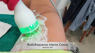 Radiofrequenza Interno Coscia  Metodo AIP [upl. by Vevay]